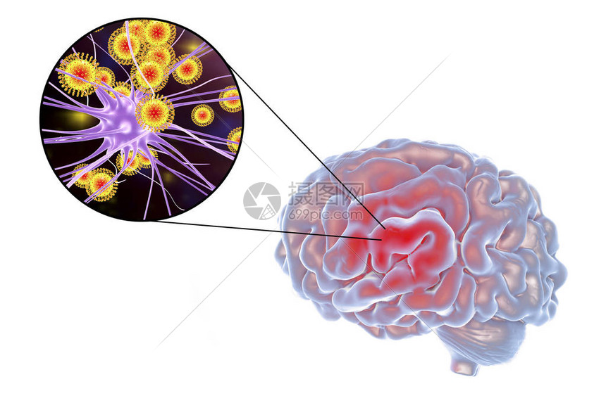 3D插图显示大脑和突变神经元图片