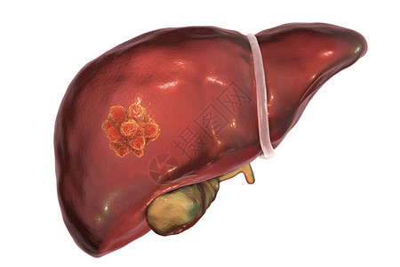 肝癌3D显示肝脏内肿图片