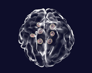 大脑加密孔径瘤3D插图图片