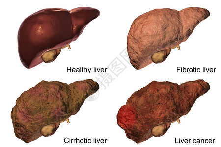 昂科威肝炎B和丙型肝炎感染的肝病发率上插画