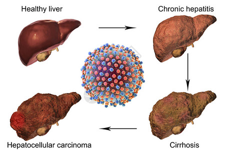肝炎C感染的肝病例增图片