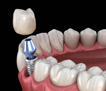 种植体修复前磨牙人类牙齿和假牙概念的医学上准确的背景图片