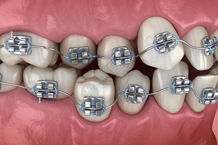 异常牙齿姿势和金属牙套对立医学上准确的图片