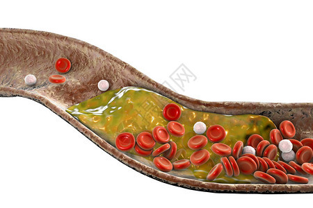 动脉中的胆固醇斑块3D插图冠状背景图片