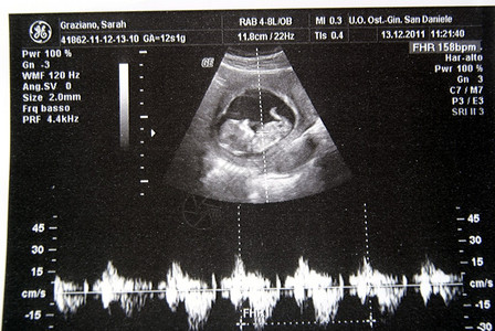 我的新出生婴儿的超声波图片