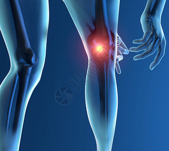 炎症疼痛膝盖X射线骨架图片