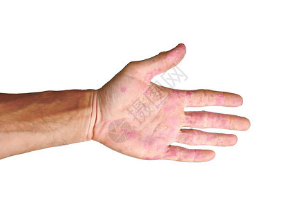 手掌病人红斑在溃疡中从白色背景分离的炎图片