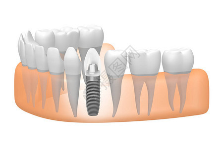 种植牙种植牙背景图片