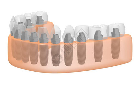 种植牙种植牙背景图片