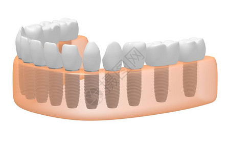 种植牙种植牙背景图片