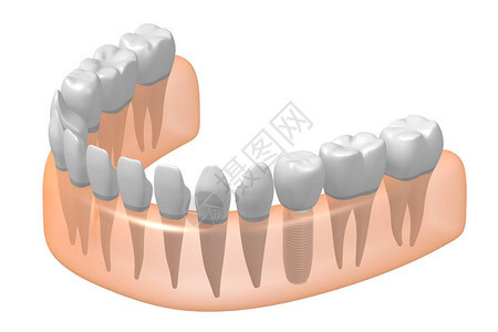 种植牙种植牙背景图片