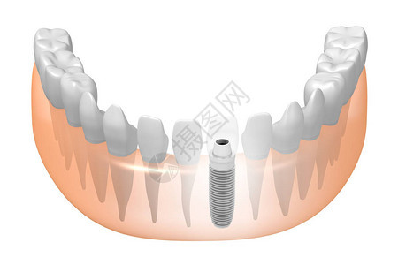 种植牙种植牙背景图片