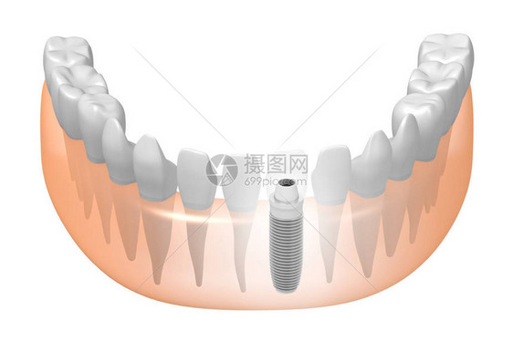 种植牙种植牙图片