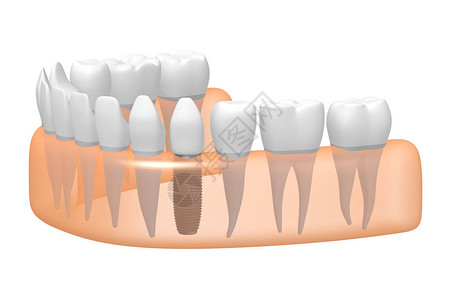 种植牙种植牙背景图片