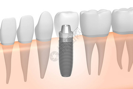 种植牙种植牙背景图片