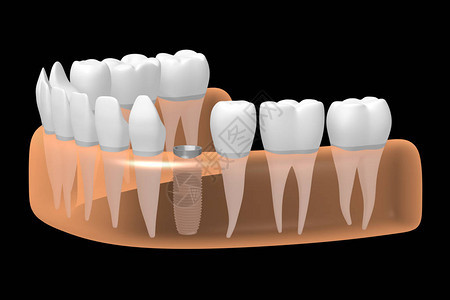 种植牙种植牙背景图片