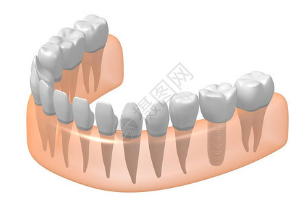 种植牙种植牙背景图片