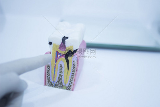 牙科诊所外科办公室牙齿照片内侧显示腐烂导致疼痛和牙痛凝胶和根部的牙图片