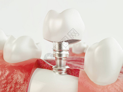 牙齿人类植入物牙科概念人类牙齿或假牙图片