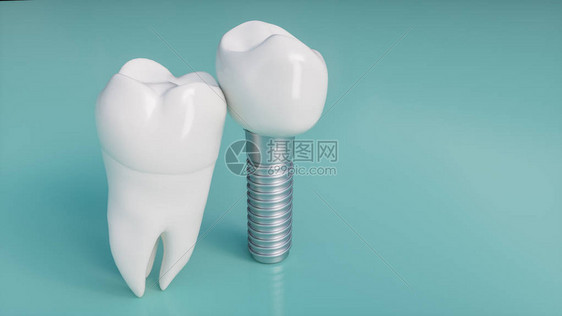 牙齿人类植入物牙科概念人类牙齿或假牙图片