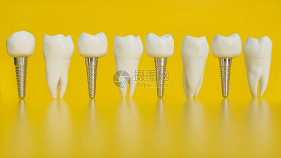 人工植牙人类牙齿或假牙在黄色背景图片