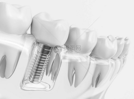 牙齿人类植入物牙科概念人类牙齿或假牙图片