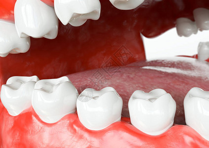 牙齿人类植入后牙科概念人类牙齿或假牙3d渲染图片