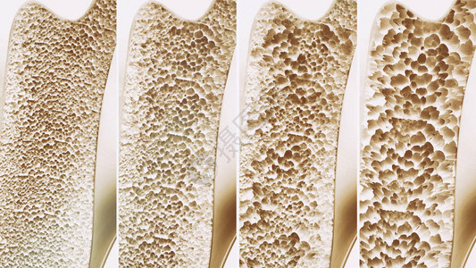 一张照片中的骨质疏松症4图片