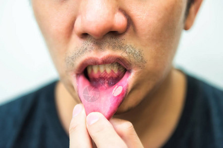 丑陋男人嘴部疼痛的aphtha溃疡复制文本的空间图片