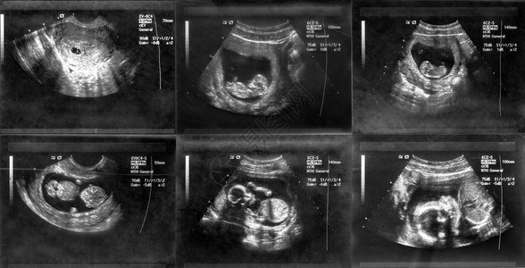 对胎儿黑白和黑色照片背景图片
