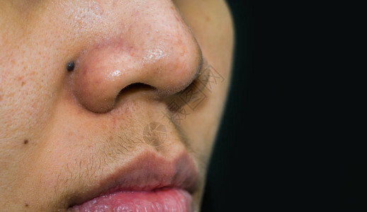 鼻子后面的黑痣需要CO2激光去除亚洲女人鼻子上的黑头粉刺粉刺和毛孔粗大的皮肤需要AHABHA或过氧化苯甲酰过量的男荷尔蒙背景图片