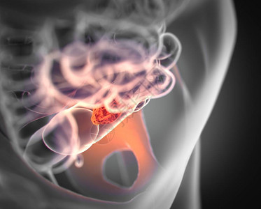 结直肠癌解剖model3d插图图片