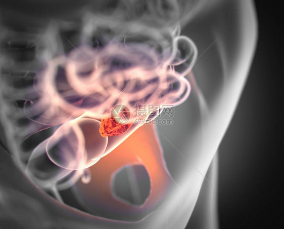 结直肠癌解剖model3d插图图片