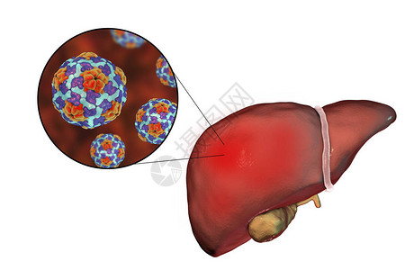 肝炎A感染和对乙型肝炎A的近图片