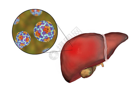 肝炎A感染和对乙型肝炎A的近图片