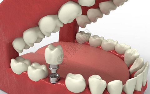 牙齿人类植入物种植牙的概念人类牙齿或假牙和科工具3D渲染背景图片
