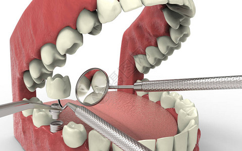 牙齿人类植入物种植牙的概念人类牙齿或假牙和科工具3D渲染图片