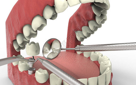 牙齿人类植入物种植牙的概念人类牙齿或假牙和科工具3D渲染图片