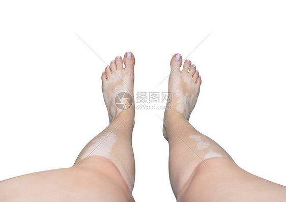 一位年轻的高加索妇女腿脚和腿部从维蒂里戈病中扎根图片