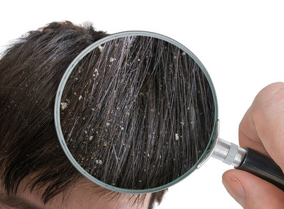 用放大镜检查头发上的头皮屑片图片