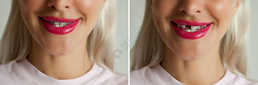 断牙和种植牙前后背景图片