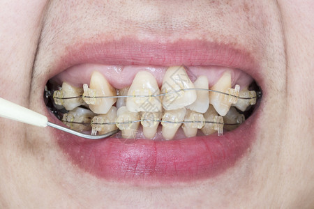 带牙套和牙菌斑去除剂的歪牙特写嘴背景图片