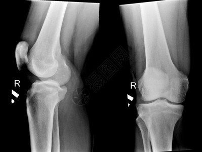 人体膝关节X光片黑白照片图片