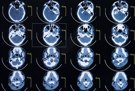 脑计算机断层成像图系列由脑部电图片