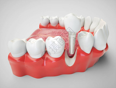 以下巴模型为例的牙科植入图片