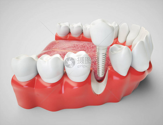 以下巴模型为例的牙科植入图片