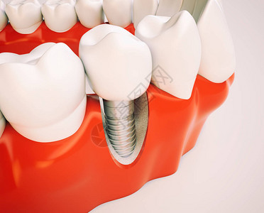 以下巴模型为例的牙科植入图片