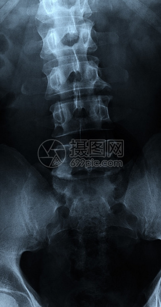 扫描腰椎前后位X光片图片