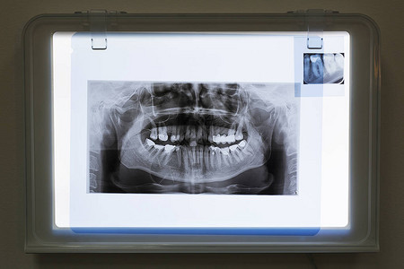 查看下颌和牙齿的X光片图片