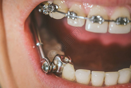 用于深咬合的牙套和牙科器具图片